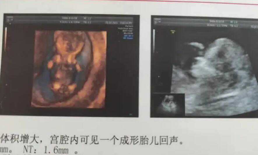 助代怀孕包成功_代怀孩子_2022台湾试管婴儿费用多少，哪些因素影响了台湾试管